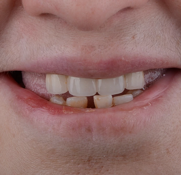 <span class="bt_bb_before_after_image_before_text"> Before</span>